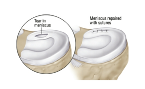 Meniscal Repair by Arthroscopy