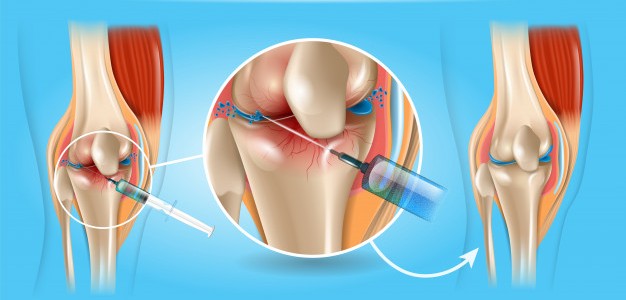 viscosupplementation treatment noida