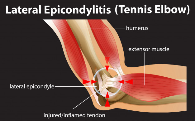 tennis Elbow diagram