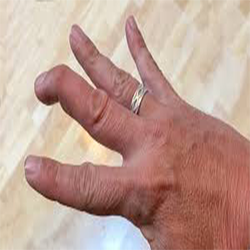 bent tip of finger showing mallet finger