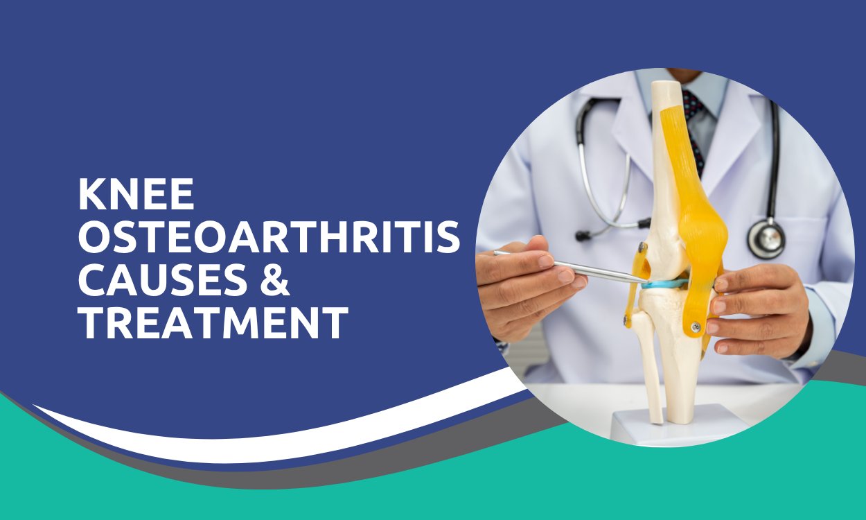 Knee Osteoarthritis Causes & Treatment