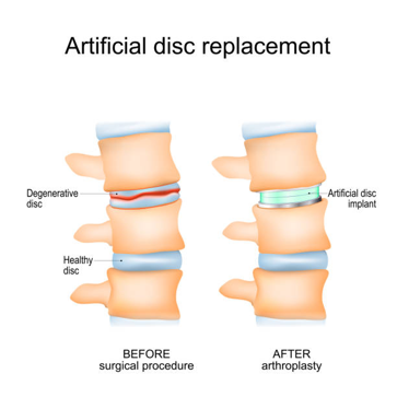 Diagram of artificial disc replacement in the spine: left shows a degenerative disc before surgery; right shows the artificial disc implant after arthroplasty.