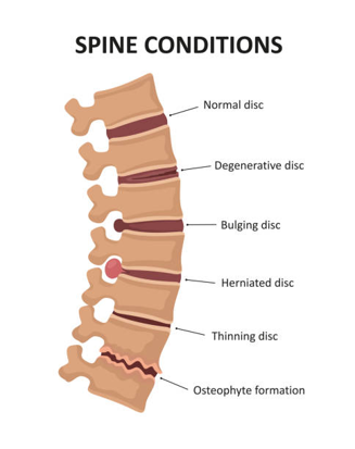 Educational diagram of the spine with labeled conditions: normal disc, degenerative disc, bulging disc, herniated disc, thinning disc, and osteophyte formation