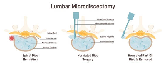 Three-panel diagram of lumbar microdiscectomy showing spinal disc herniation, herniated-disc surgery, and removal of the herniated portion in each step