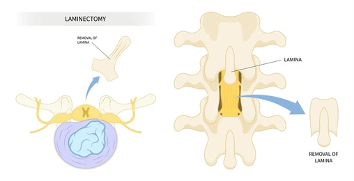Two-panel diagram of a laminectomy: left shows removal of the lamina to access the spinal cord; right shows the vertebral arch after lamina removal exposing the spinal canal.