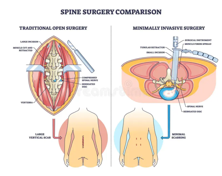 Comparison of traditional open spine surgery vs. minimally invasive spine surgery, with labeled cross‑sectional views and patient silhouettes below