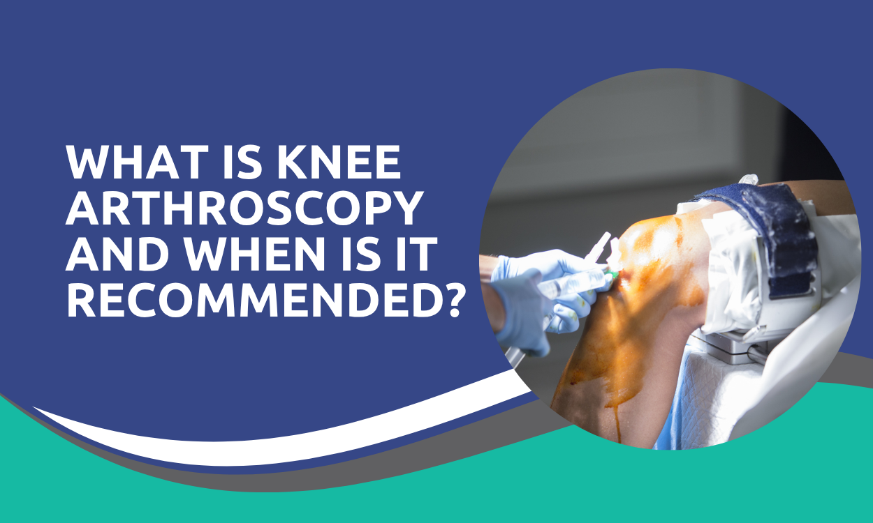 What Is Knee Arthroscopy and When Is It Recommended