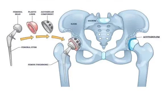Diagram of a total hip replacement showing a prosthetic femoral stem and ball being implanted into the femur, plus an acetabular cup into the pelvis, with labeled components such as femoral head, plastic liner, and acetabular component.