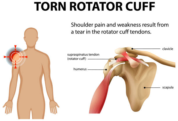 Illustration of a torn rotator cuff causing shoulder pain, showing a highlighted shoulder on the left and a labeled shoulder anatomy diagram (clavicle, supraspinatus tendon, humerus, scapula) on the right.