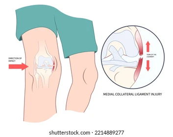 Diagram of a knee showing an injury to the medial collateral ligament (MCL); red arrows indicate the direction of impact, with a circular inset illustrating the ligament injury and its location on the knee.