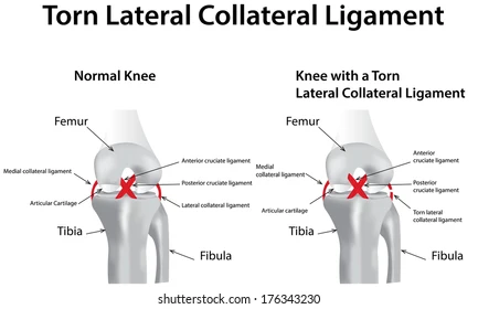 Side-by-side knee diagrams: left shows a normal knee with labeled ligaments; right shows a knee with a torn lateral collateral ligament, marked by a red X.