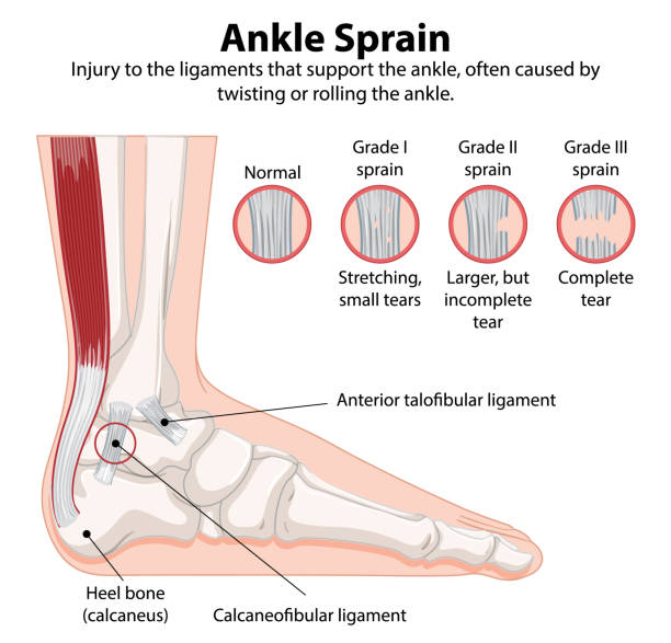 Diagram of an ankle in side view showing bones and ligaments (calcaneofibular and anterior talofibular ligaments) with insets comparing normal to Grade I–III sprains: stretching, larger incomplete tear, and complete tear.