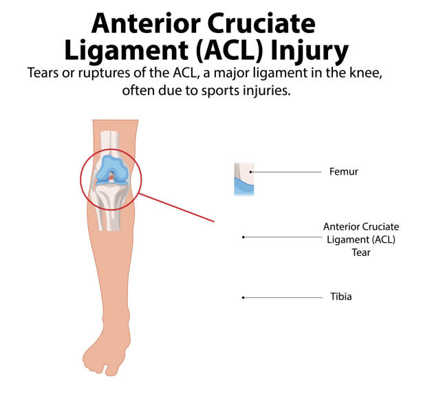 Infographic about ACL injury: diagram of a leg knee with a torn anterior cruciate ligament circled, showing femur and tibia labels.