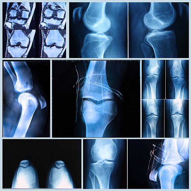 Collage of knee X-rays in blue tint showing bones from multiple angles, including post-surgical images with wires/plates.
