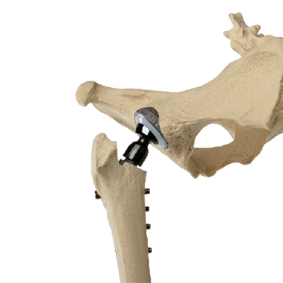 Hip-Replacement-Joint-Replacement.png